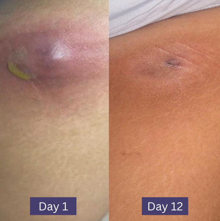 Wonder Relief | The Multi Stage HS and Boil Healing Balm