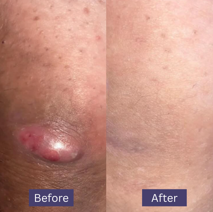 Wonder Relief | The Multi Stage HS and Boil Healing Balm