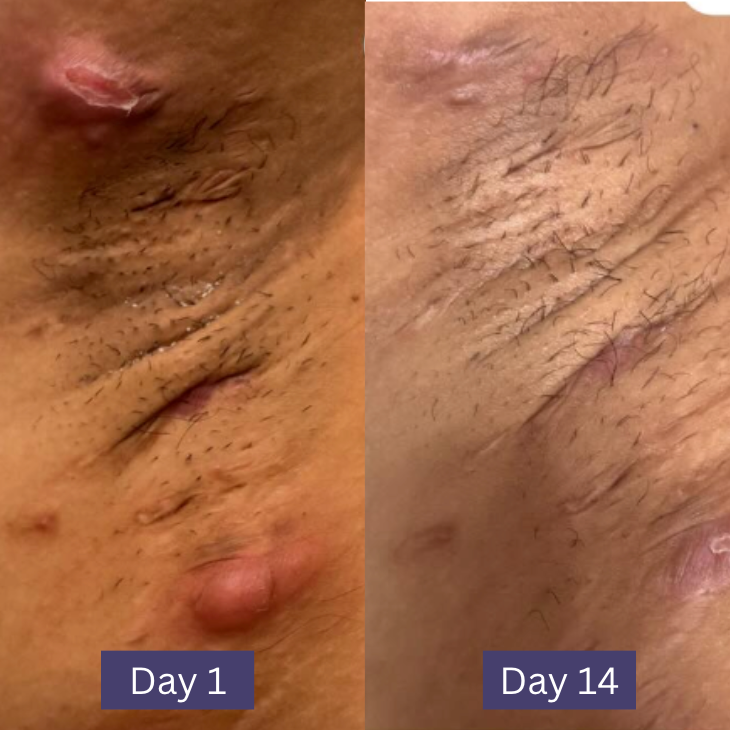 Wonder Relief | The Multi Stage HS and Boil Healing Balm