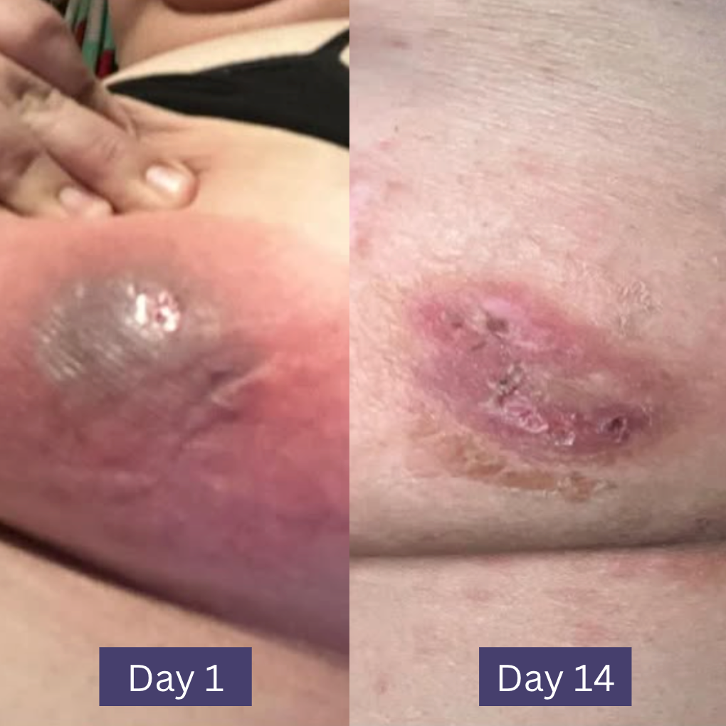 Wonder Relief | The Multi Stage HS and Boil Healing Balm