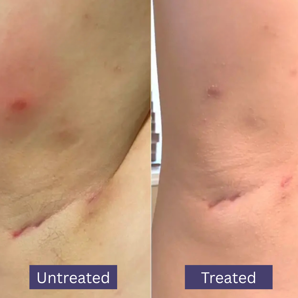 Wonder Relief | The Multi Stage HS and Boil Healing Balm