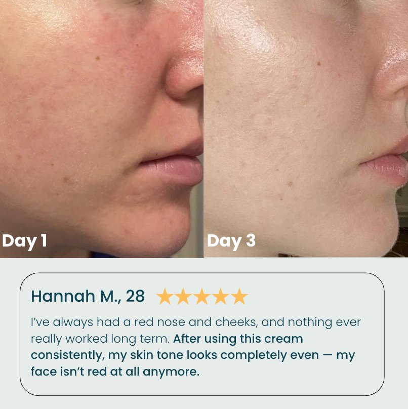 Wonder Relief | Natural Soothing Serum for Redness & Rosacea