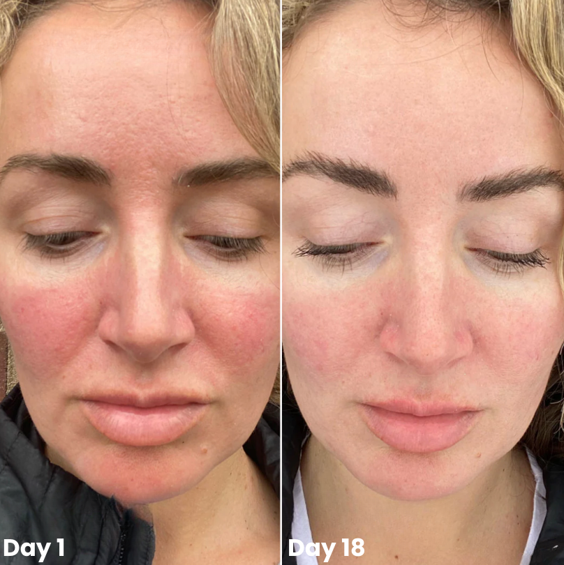 Wonder Relief | Natural Soothing Serum for Redness & Rosacea