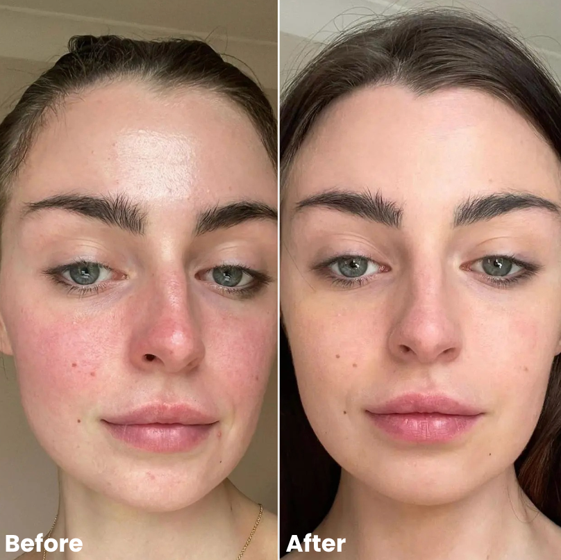 Wonder Relief | Natural Soothing Serum for Redness & Rosacea