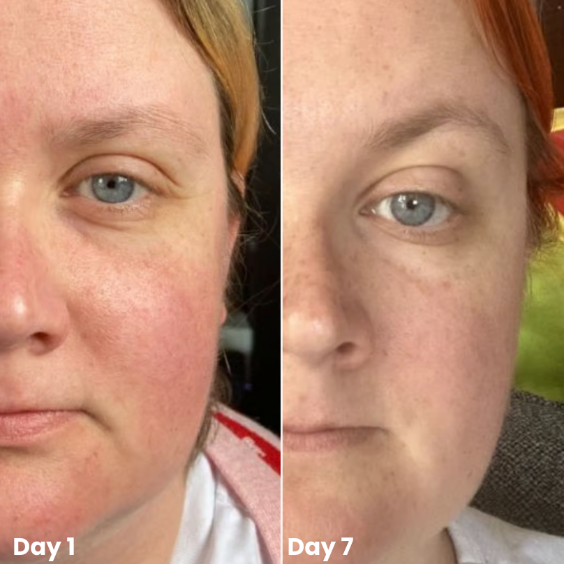Wonder Relief | Natural Soothing Serum for Redness & Rosacea