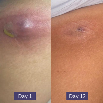 Wonder Relief | The Multi Stage HS and Boil Healing Balm