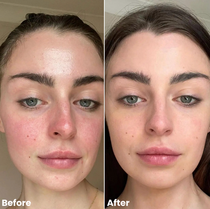 Wonder Relief | Natural Soothing Serum for Redness & Rosacea